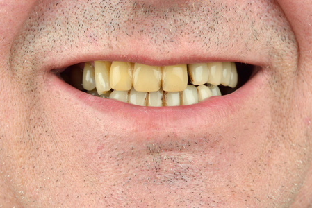 详细的形象的人露出的牙齿.牙科保健服务.霉素照片