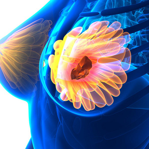 乳腺癌-女性解剖-分离在白色照片