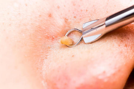 满脸痘痘用爆米花装置挤痘痘黑头照片