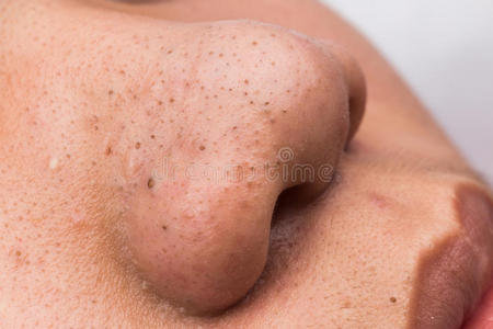 痤疮鼻子鼻子上粉刺黑头的闭合照片