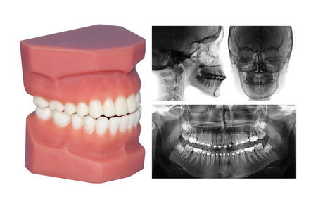 牙齿模型和头影测量 x 射线与一个孤立
