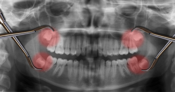 在 x 射线显示四颗智齿