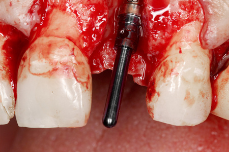 牙外科植入物视图