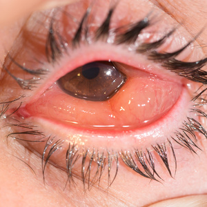 灯试验球结膜水肿在眼试验照片