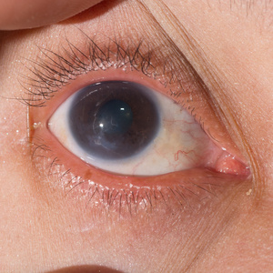 角膜炎眼试验