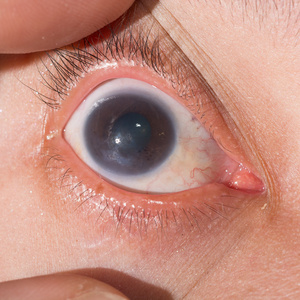 在眼科检查期间角膜炎