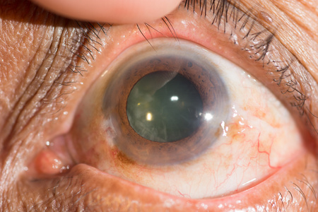 老年近视老年性白内障眼测试照片