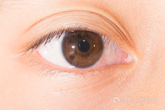 检查眼睛虹膜结节