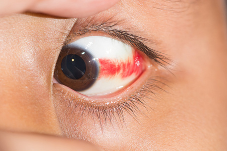 球结膜下出血在眼试验图片