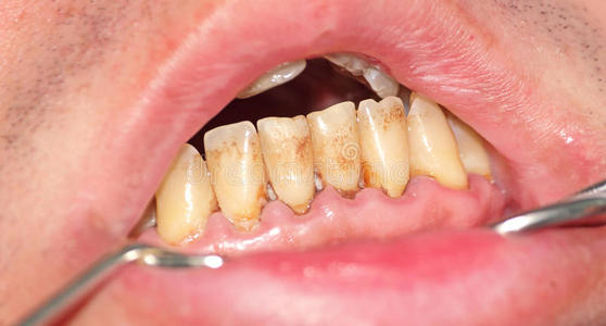 病人 牙龈炎 照顾 牙齿 卫生 临床 治疗 病理学 医学