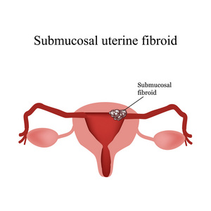 黏膜下子宫肌瘤。子宫内膜异位症。信息图表。对孤立背景矢量图