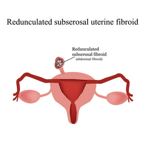 带蒂的浆膜下子宫肌瘤。信息图表。对孤立背景矢量图