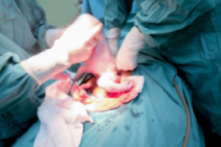 模糊图像剖宫产怀孕母亲分娩婴儿从底部出错误的位置的手术室