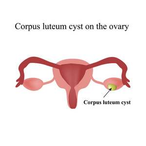 对卵巢黄体囊肿。功能性囊肿。子房。信息图表。对孤立背景矢量图