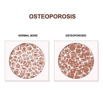 骨质疏松症。疾病的特点是低骨量