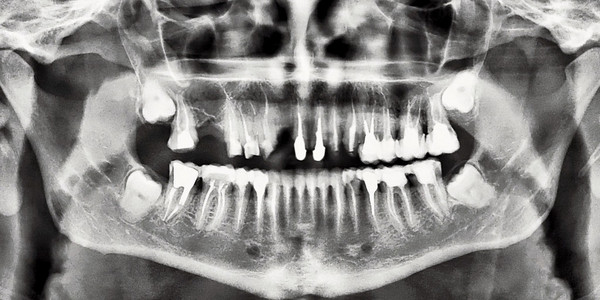 x 射线的牙齿