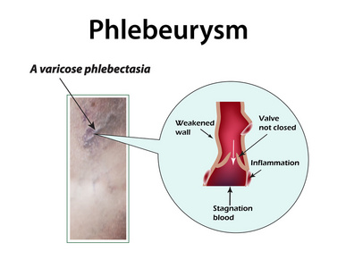 静脉曲张支气管扩张。Phlebeurysm。血栓形成。血栓性静脉炎。信息图表。对孤立背景矢量图