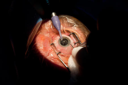 白内障眼科手术照片