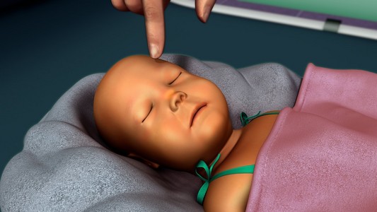 新生儿黄疸图片