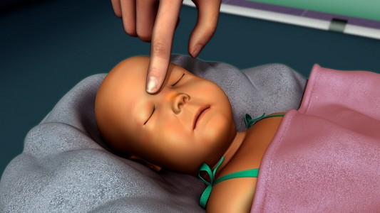 光疗灯刚出生的婴儿黄疸照片