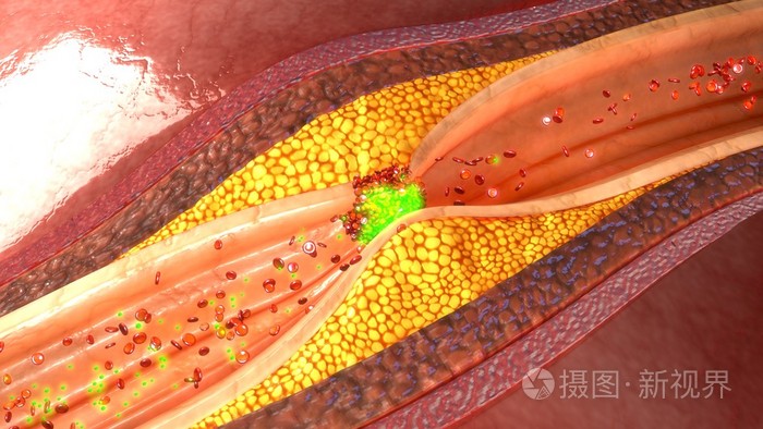 血管内溶栓治疗