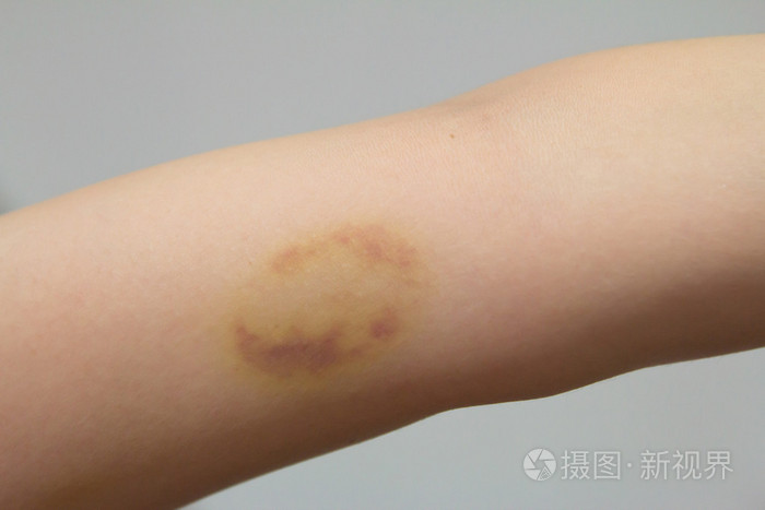 擦伤伤口女性手臂上照片-正版商用图片1oaxah-摄图新视界