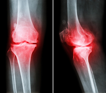 薄膜 x 射线膝盖 (前