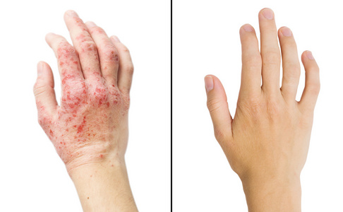 女孩的手,湿疹治疗前后患者的实况照片插画