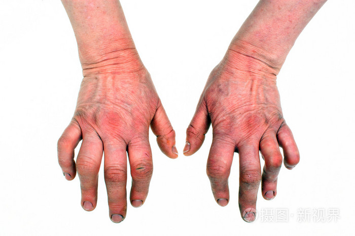 类风湿关节炎的手