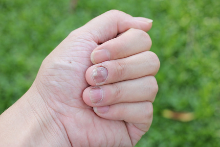 指甲上的真菌感染,手指伴有真菌病.照片