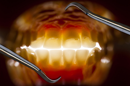 intraoral口腔内部视图嘴口内入路照片