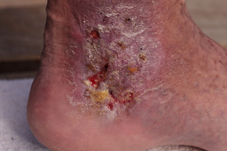 皮肤炎医学图片︰ 对皮肤的踝关节感染蜂窝织炎照片