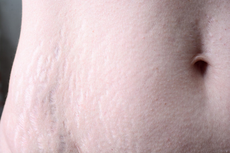 腹部长妊娠纹图片