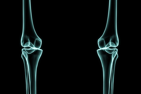 右膝关节置换术图片