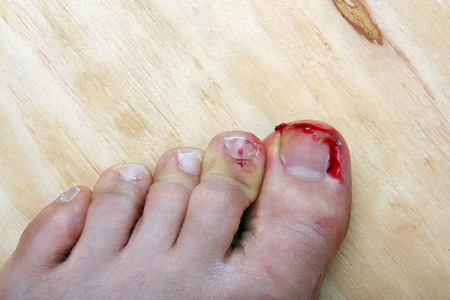 破出血指甲治疗后的嵌趾甲去除嵌的趾甲嵌的趾甲敷料肿胀的柔软秀发