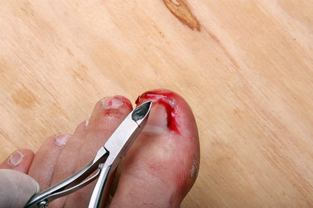 瘭破出血指甲照片