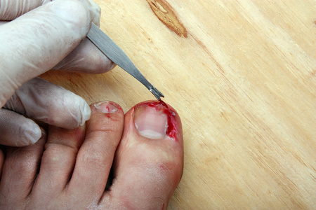 瘭破出血指甲照片