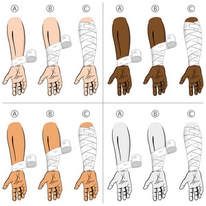 手臂绷带包扎法图片
