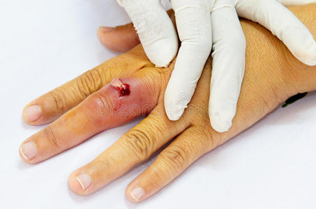 引流脓肿伤口护理照片