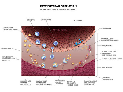 动脉脂肪条纹的形成