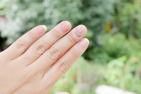 指甲手真菌感染, 手指与甲真菌病, 脚趾甲真菌.-软对焦照片