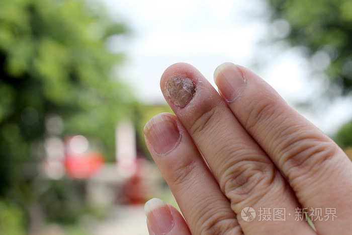 指甲手真菌感染, 手指与甲真菌病, 脚趾甲真菌。软对焦