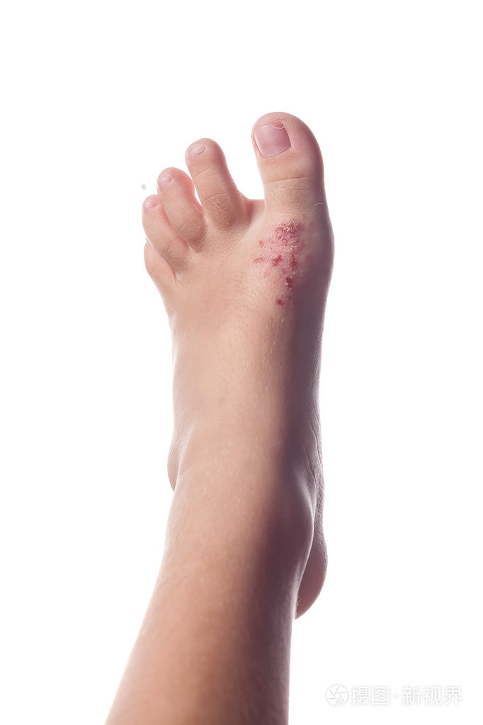 湿疹异位性皮炎在孩子的脚的皮肤湿疹的特写