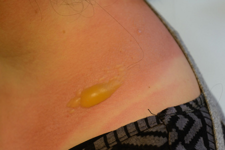 带水泡的晒伤照片