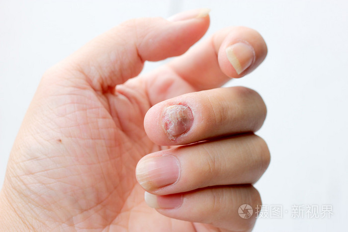 真菌感染对指甲的手手指与甲真菌病软焦点