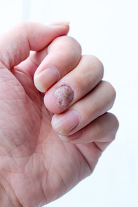 真菌感染对指甲的手,手指与甲真菌病.-软焦点照片