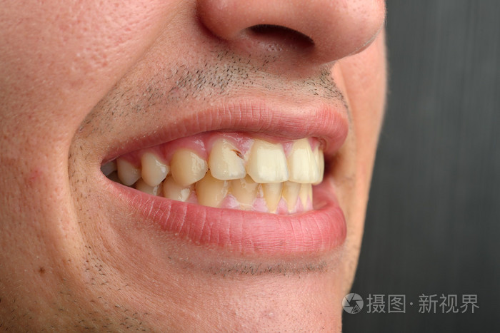 详细的形象的人露出的牙齿。牙科保健服务。卫生。牙科