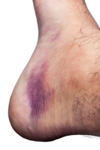 压伤的脚踝后绊倒和扭曲照片