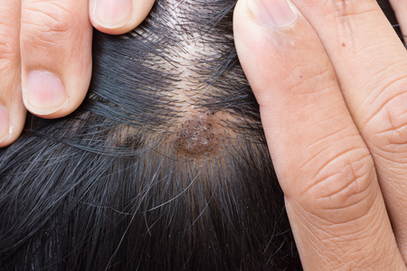 角化型湿疹图片-角化型湿疹素材-角化型湿疹插画-摄图新视界