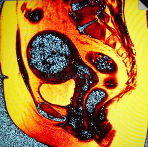 乳腺癌检查成熟的绿樱桃月桂叶子宫内膜异位症电缆盘子宫和卵巢女施佩